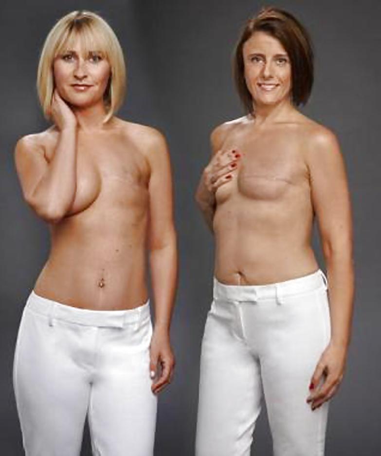 25P Amputee Mastectomy Handicapped
