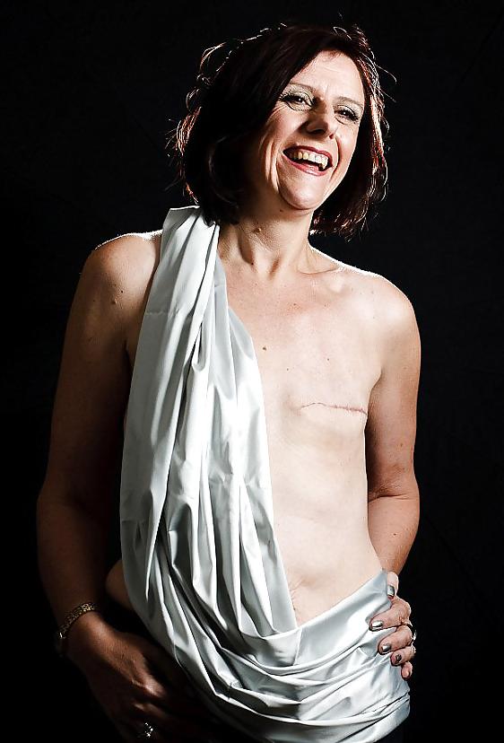 25P Amputee Mastectomy Handicapped