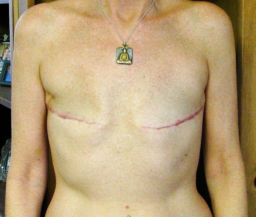 25P Amputee Mastectomy Handicapped