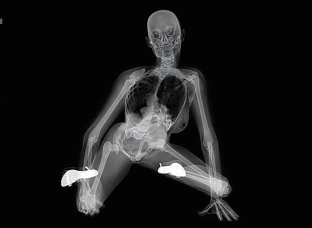 12P Erotic XRays