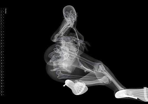 12P Erotic XRays
