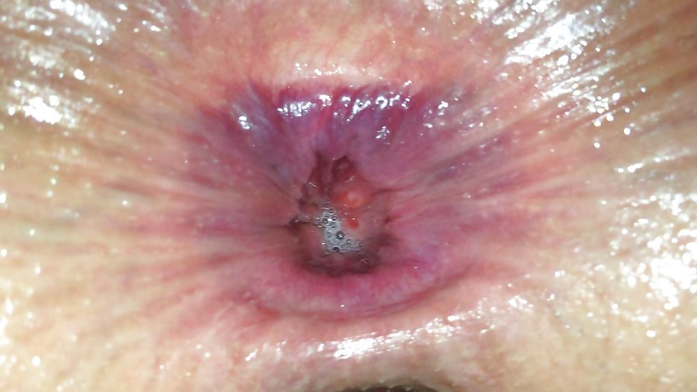25P Anal gape