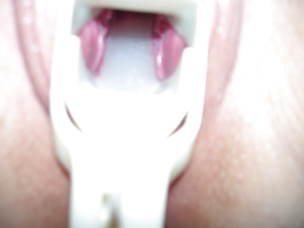 17P Speculum and Frozen cum