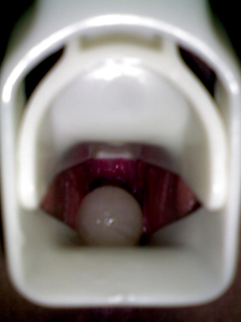 17P Speculum and Frozen cum