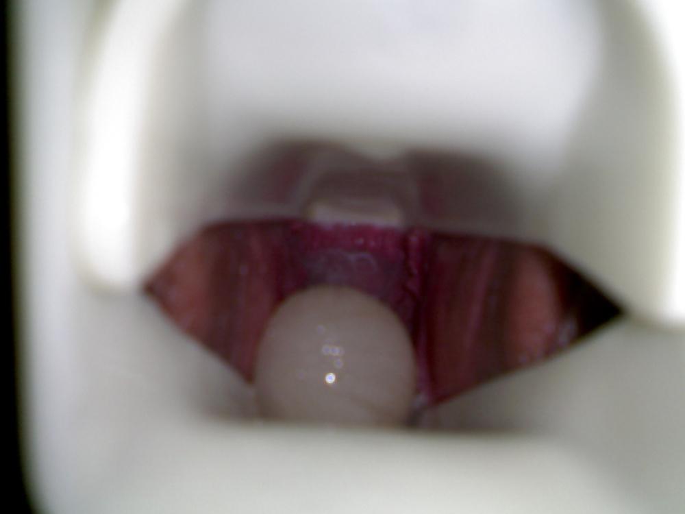 17P Speculum and Frozen cum