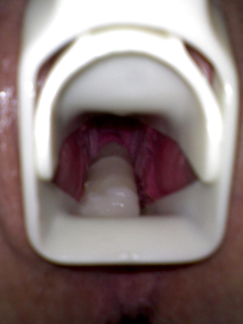 17P Speculum and Frozen cum