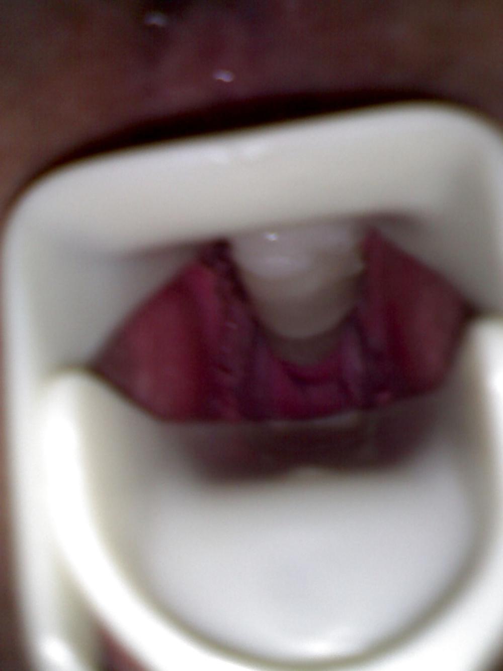 17P Speculum and Frozen cum