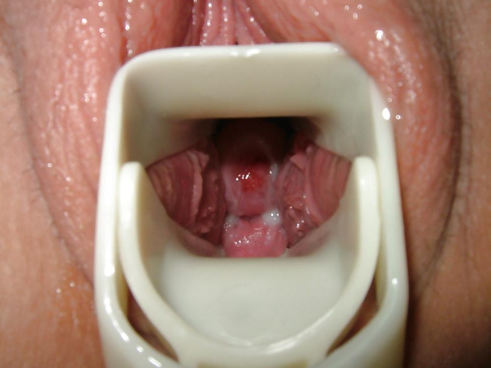 17P Speculum and Frozen cum