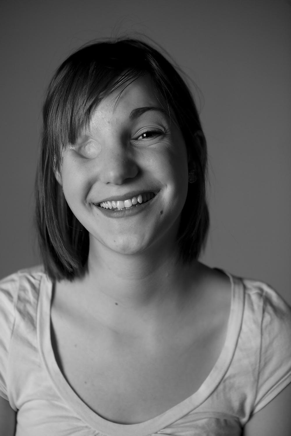 11P Very sexy girl with one missing eye -- eye amputee?