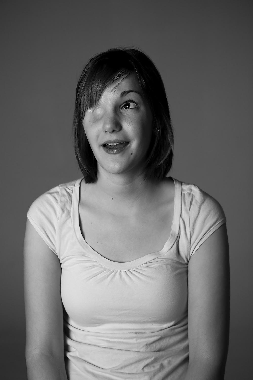 11P Very sexy girl with one missing eye -- eye amputee?