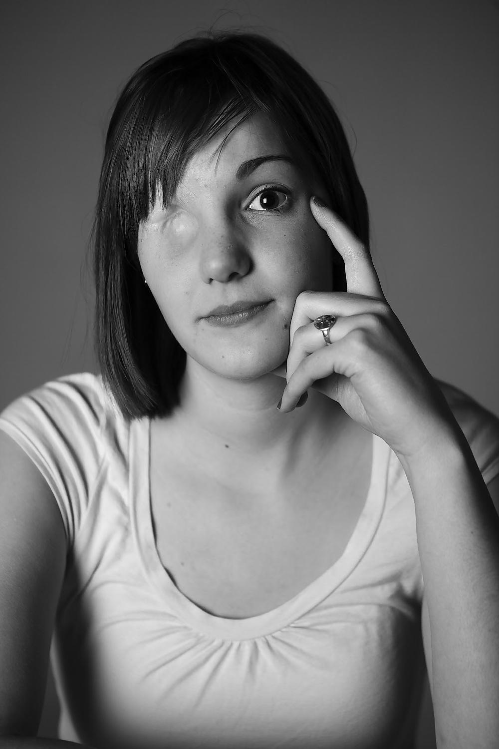 11P Very sexy girl with one missing eye -- eye amputee?