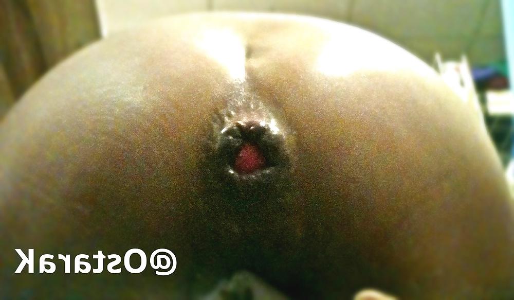 25P Anal insertions
