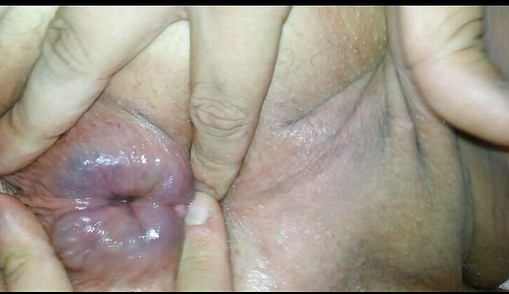 4P Anal Fisting and Prolapse