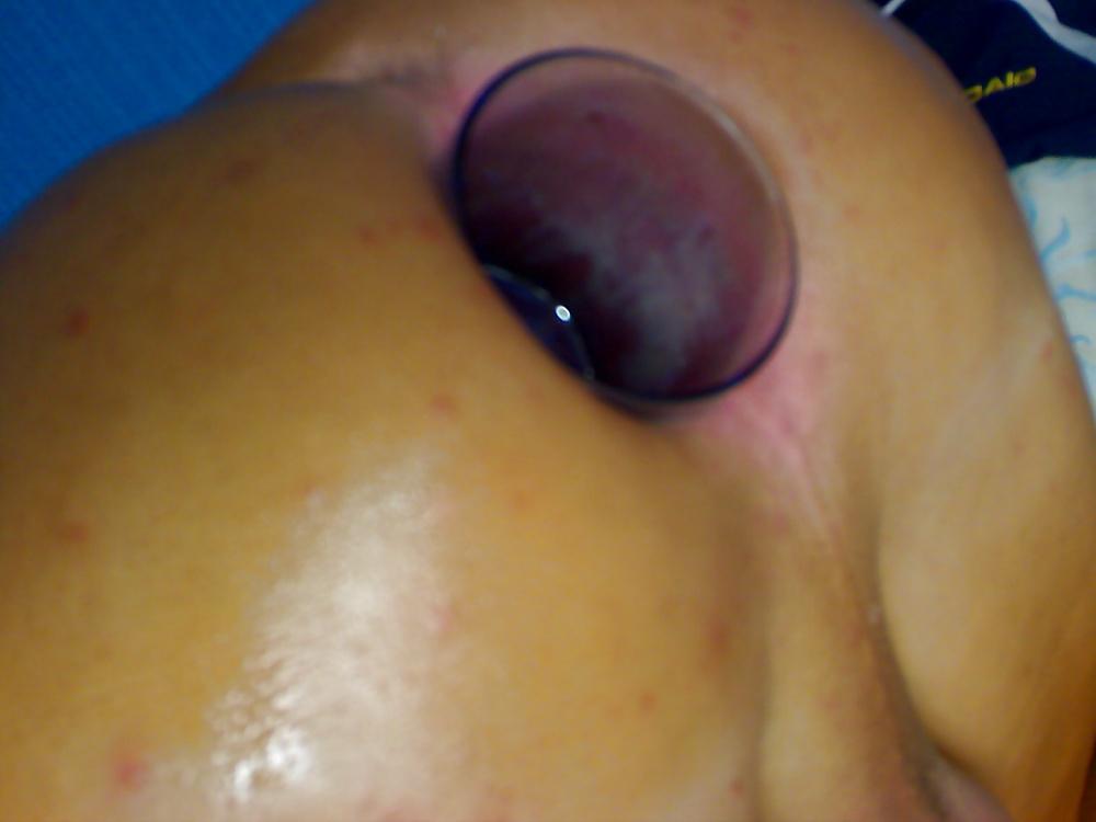 24P Dilatation anal 