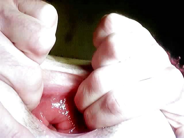 10P Anus-Anal-Rectum Gapes