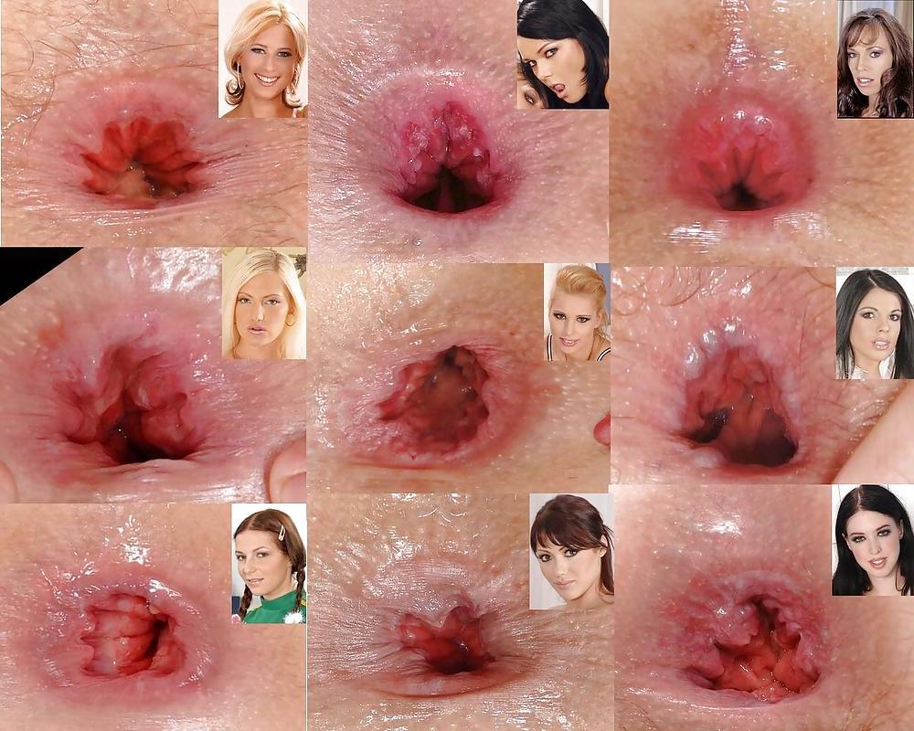 10P Anus-Anal-Rectum Gapes