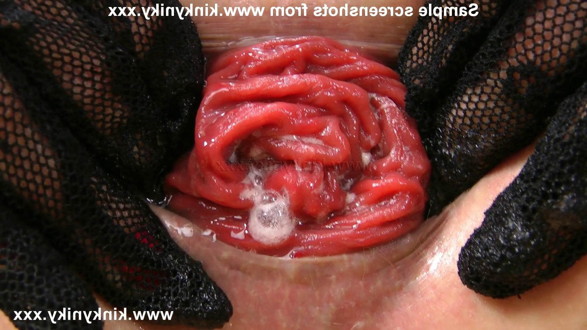16P extreme anal fisting and anal prolapse