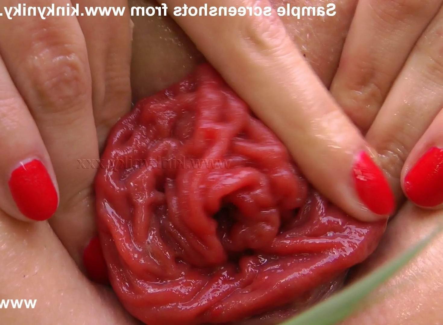 16P extreme anal fisting and anal prolapse