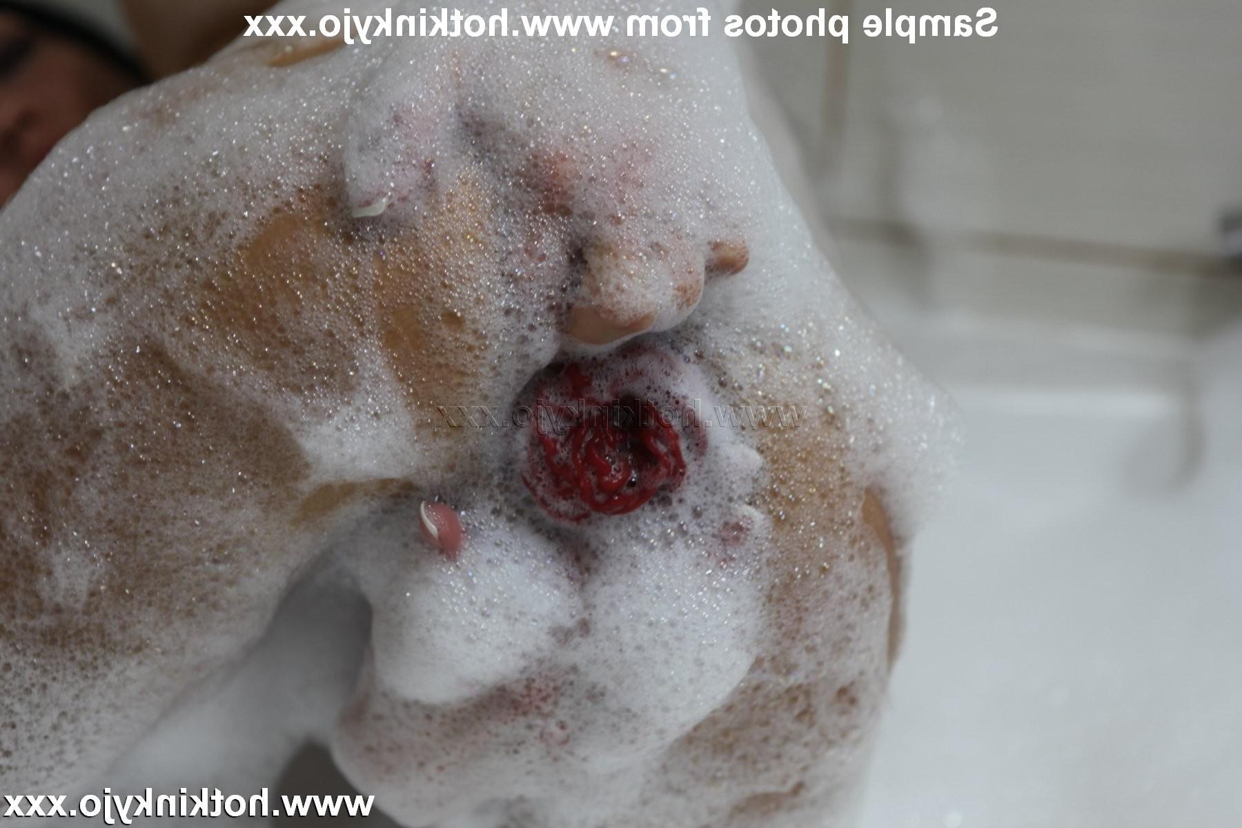 15P Extreme deep anal prolapse