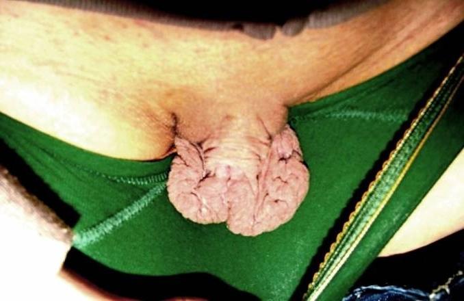 17P Real huge clit