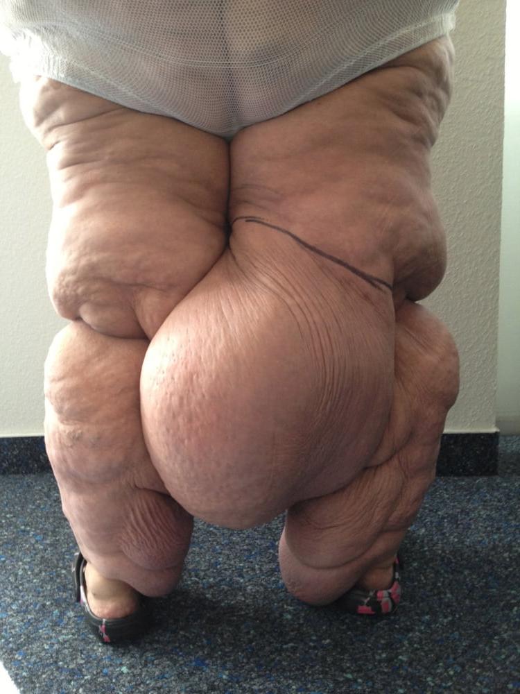 15P Asymmetrical SSBBW