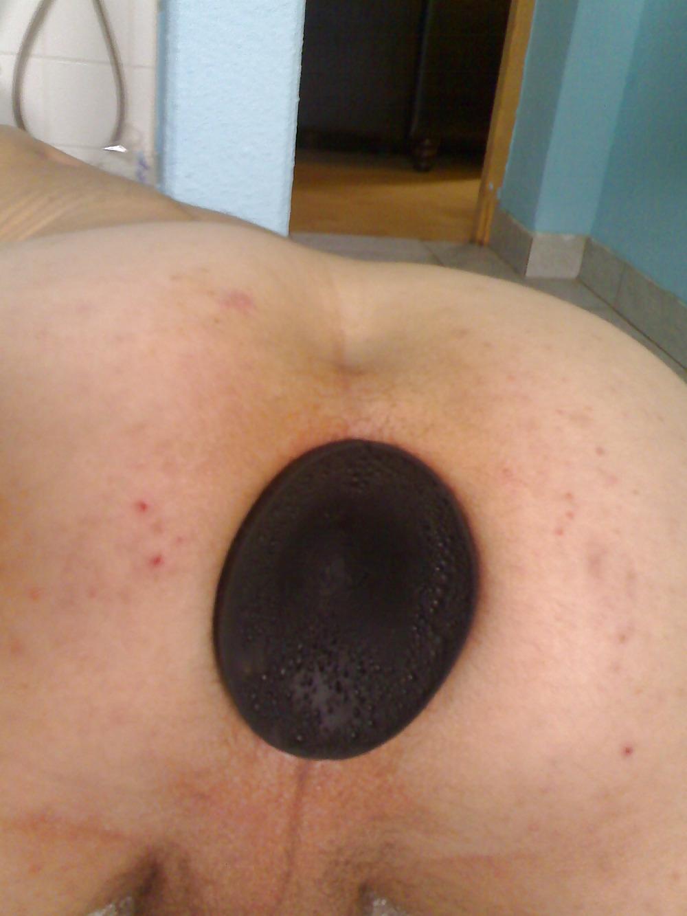 5P Anal