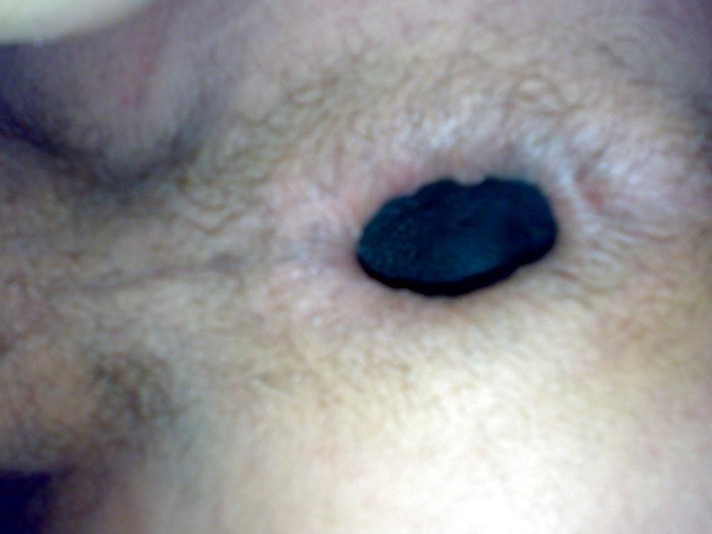 5P Anal