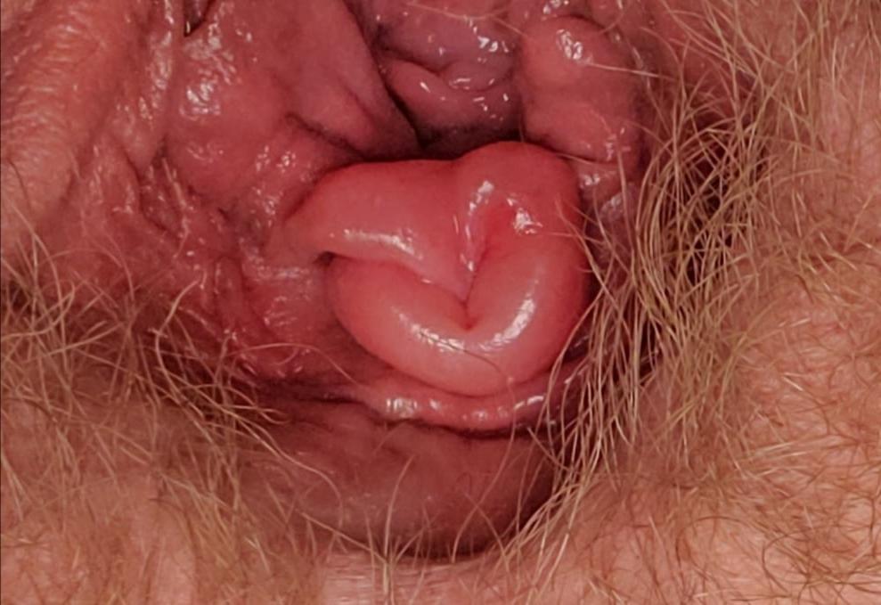 25P New tunnel plug and clit suction