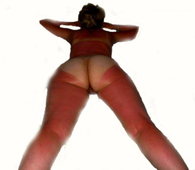 25P KEY - Tan Lines 0008 Sunburn