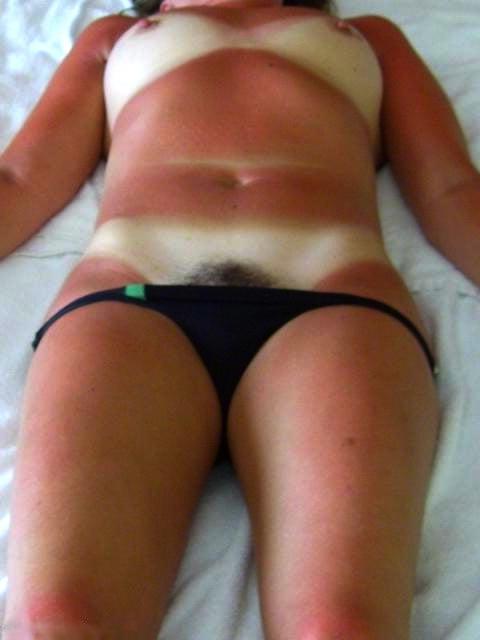 25P KEY - Tan Lines 0008 Sunburn