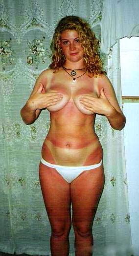 25P KEY - Tan Lines 0008 Sunburn