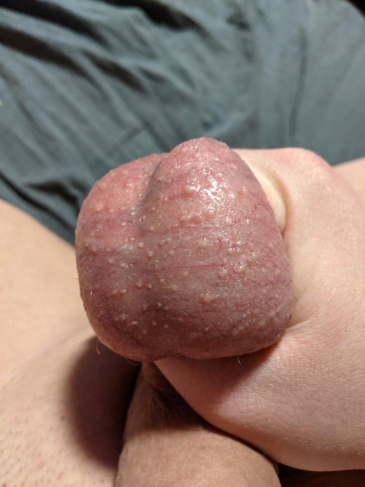 19P Ball Pictures #2 Hurting balls need a relief.