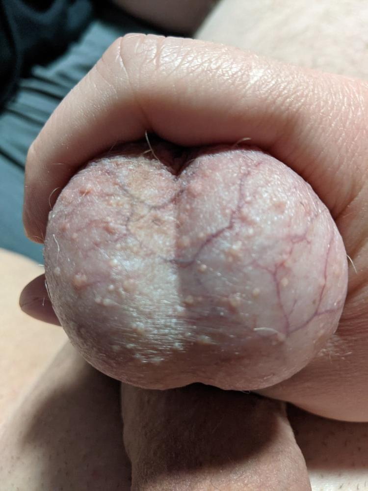20P Ball Pictures #3 My balls hurting