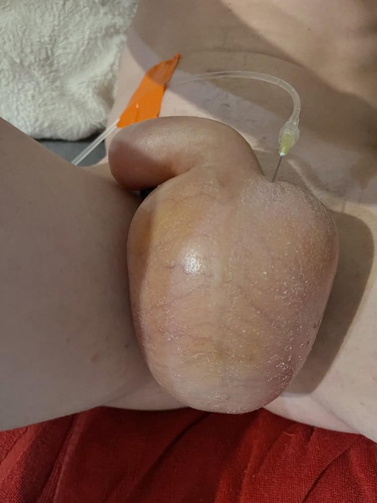 9P saline injection balls 1 liter