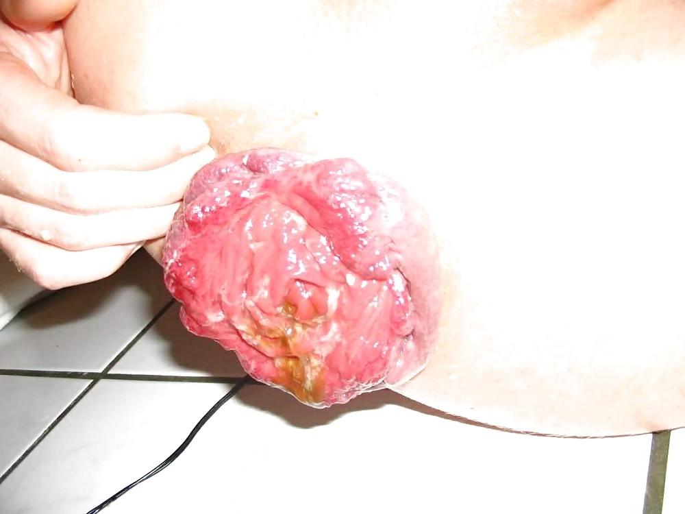 20P Prolapse Rosebud