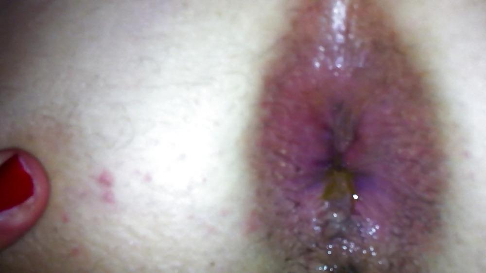 12P GAPE ANAL