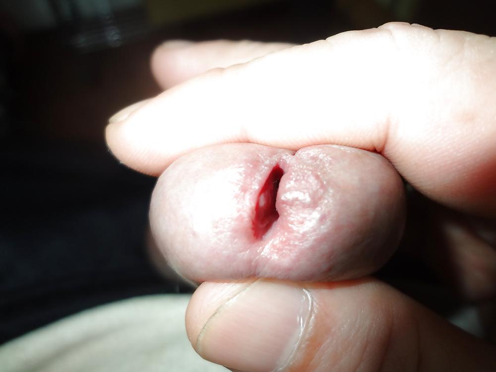 12P The urethra insertion