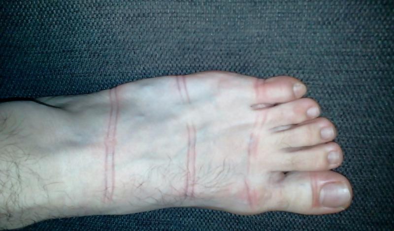15P Bound feets