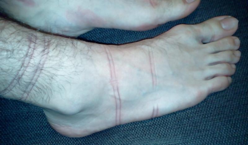 15P Bound feets