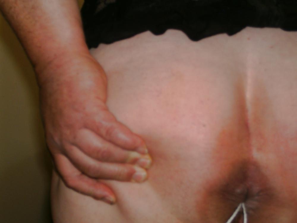 7P Tampoon insertion