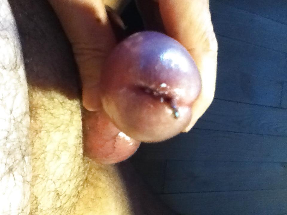 9P Urethral Insertion