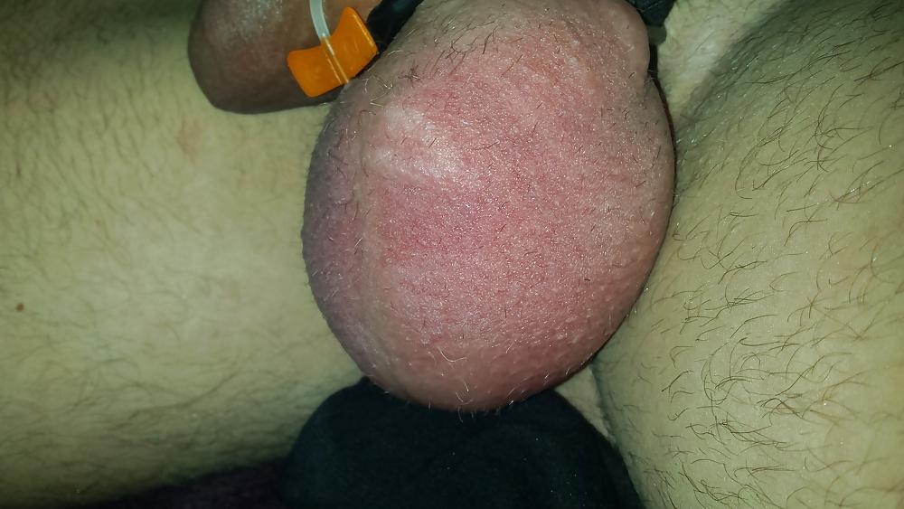 14P Saline balls