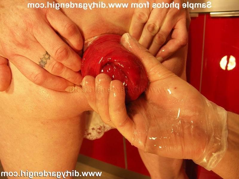 15P Extreme prolapse pumping