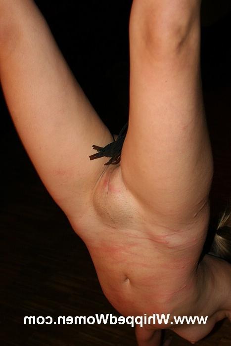 17P Attention: extreme welted skin of a young female