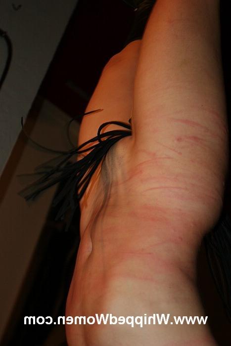 17P Attention: extreme welted skin of a young female