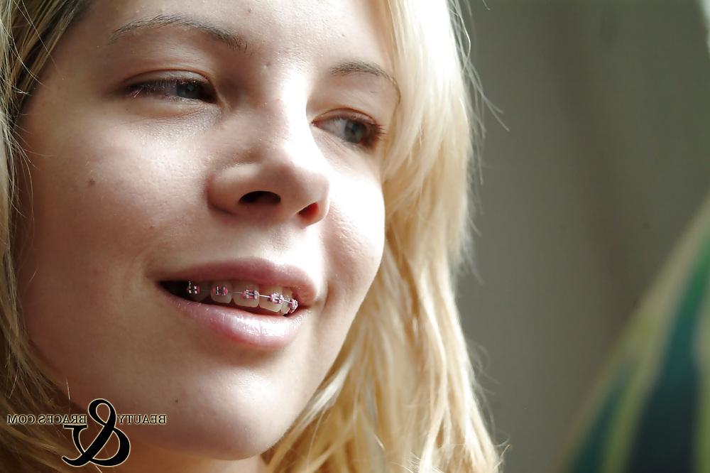 12P The most beautiful girl with braces