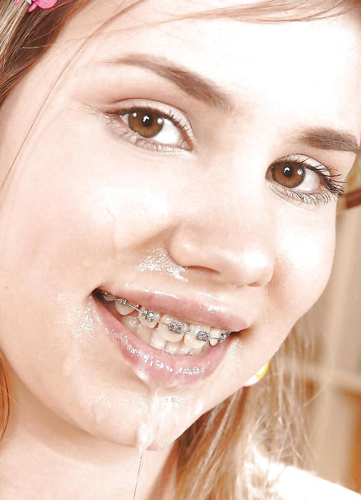 15P Braces