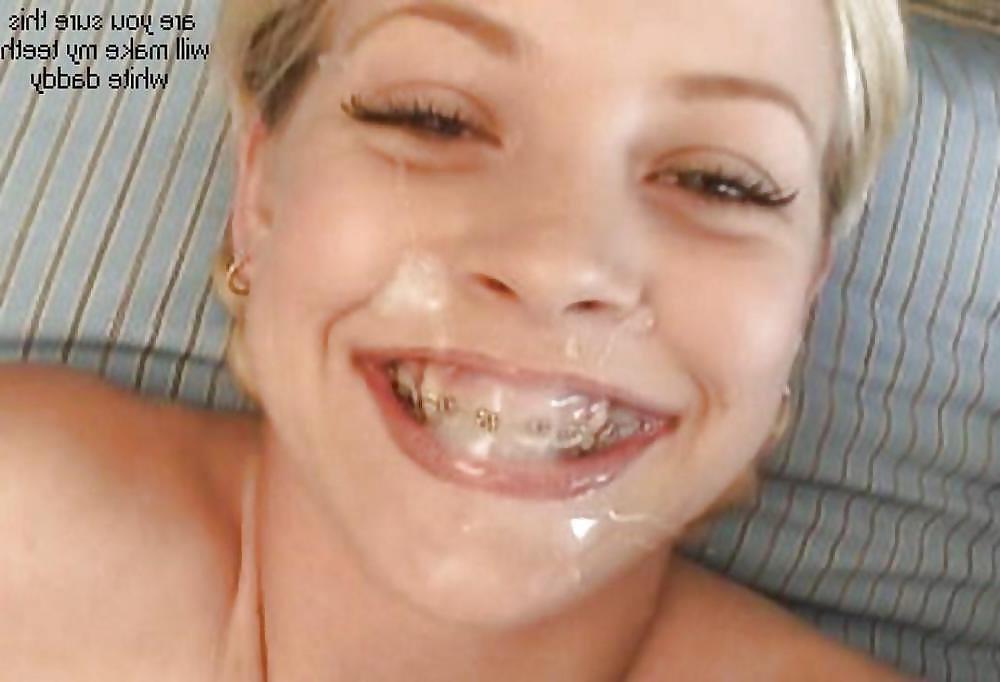 15P Braces