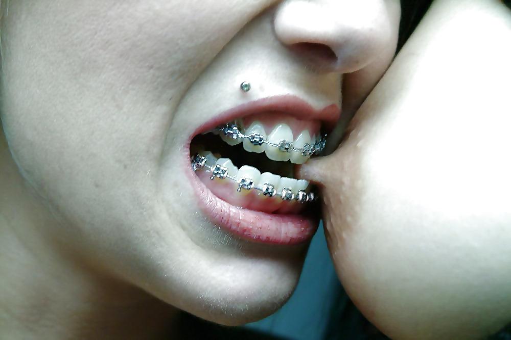 15P Braces