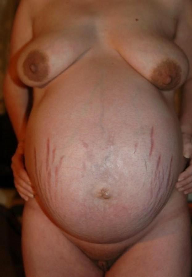 10P Pregnant Stretchmarks